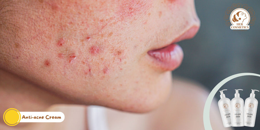 ¿Cómo deshacerse del acné facial?